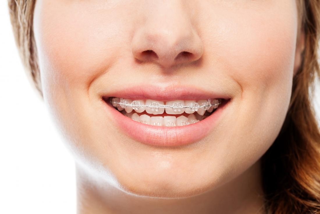 Great reasons why adults should get orthodontic braces